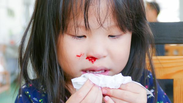 Detail Gambar Polip Hidung Pada Anak Nomer 18