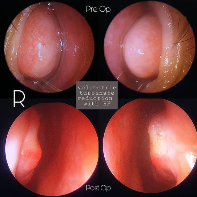 Detail Gambar Polip Hidung Pada Anak Nomer 29