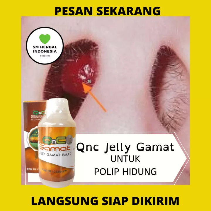 Detail Gambar Polip Hidung Pada Anak Nomer 57