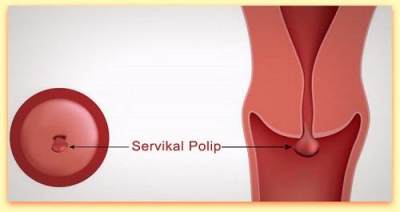 Detail Gambar Polip Serviks Nomer 22