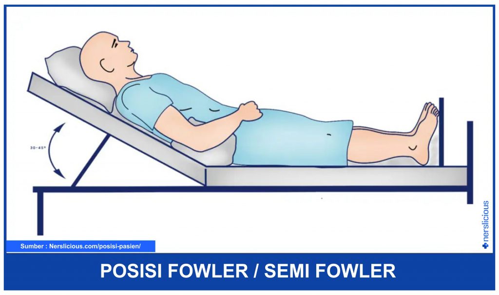 Detail Gambar Posisi Fowler Nomer 2