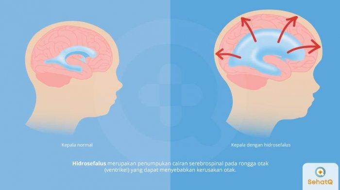 Detail Gambar Proses Cairan Serebrospinalis Dalam Otak Nomer 18