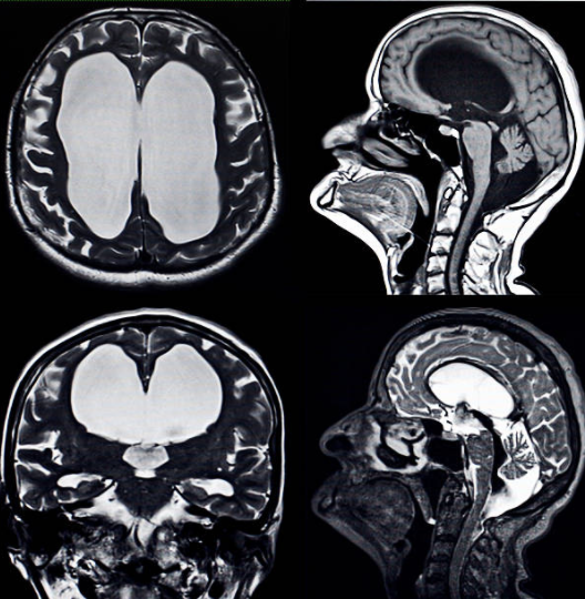 Detail Gambar Proses Cairan Serebrospinalis Dalam Otak Nomer 30