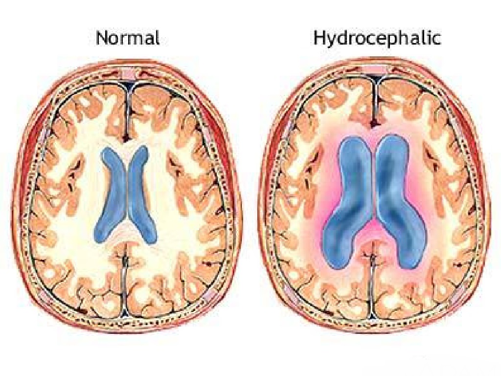 Detail Gambar Proses Cairan Serebrospinalis Dalam Otak Nomer 44