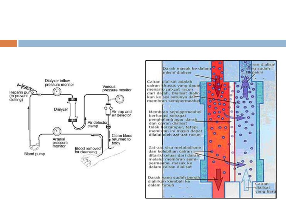 Detail Gambar Proses Dialisis Nomer 29