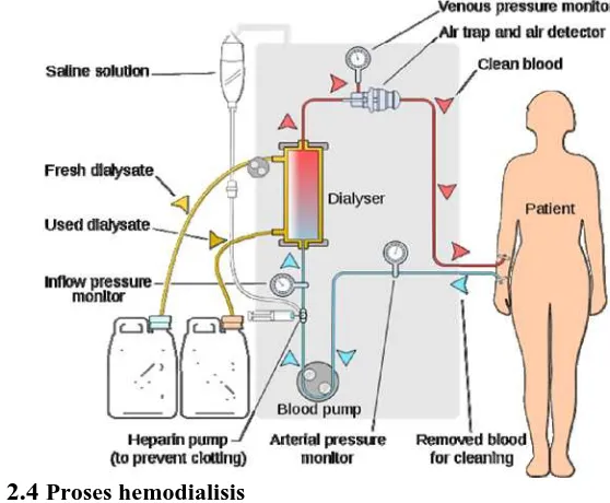 Detail Gambar Proses Dialisis Nomer 46