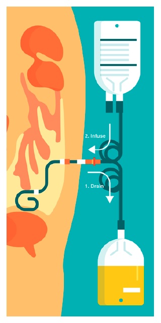 Detail Gambar Proses Dialisis Nomer 47