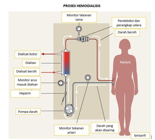 Detail Gambar Proses Dialisis Nomer 8