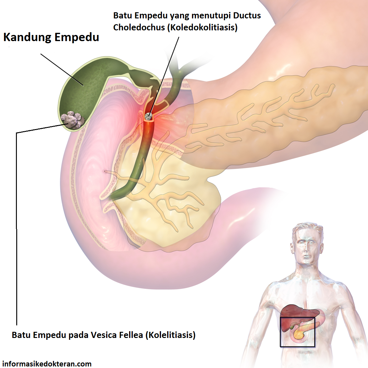 Detail Gambar Proses Keluarnya Batu Empedu Nomer 2