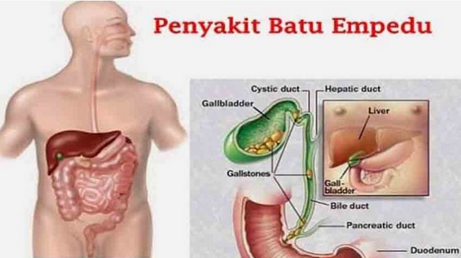 Detail Gambar Proses Keluarnya Batu Empedu Nomer 10