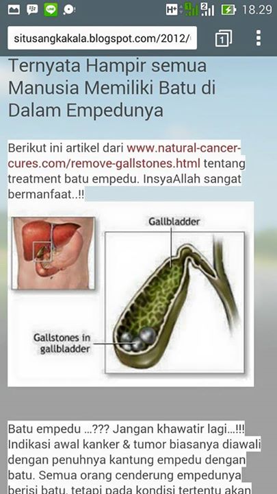 Detail Gambar Proses Keluarnya Batu Empedu Nomer 11