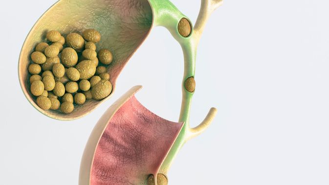 Detail Gambar Proses Keluarnya Batu Empedu Nomer 24