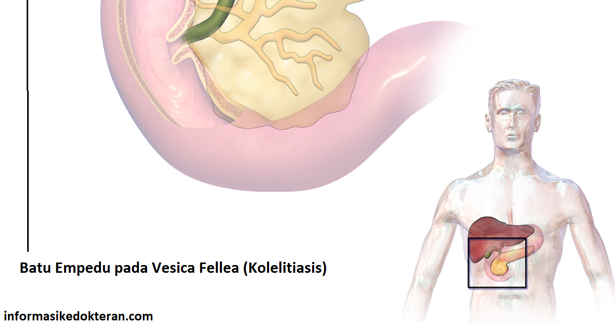 Detail Gambar Proses Keluarnya Batu Empedu Nomer 40