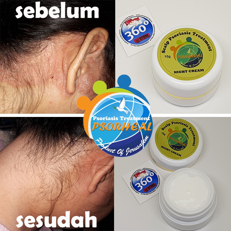 Detail Gambar Psoriasis Kulit Kepala Nomer 12