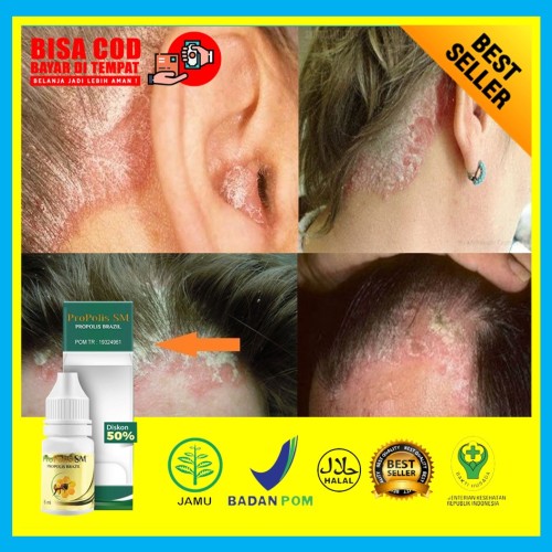 Detail Gambar Psoriasis Kulit Kepala Nomer 33