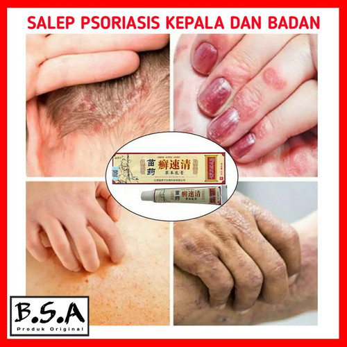 Detail Gambar Psoriasis Kulit Kepala Nomer 38