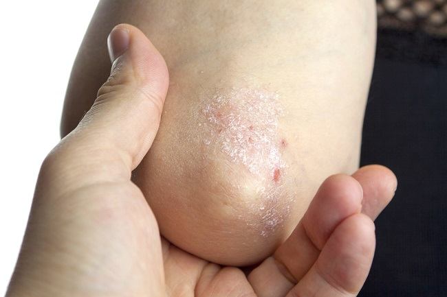 Detail Gambar Psoriasis Kulit Kepala Nomer 40