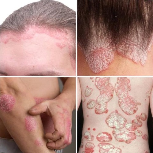 Detail Gambar Psoriasis Kulit Kepala Nomer 48