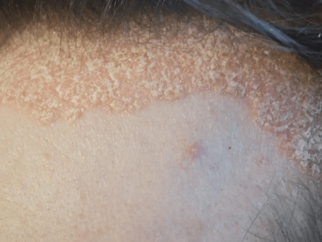 Detail Gambar Psoriasis Kulit Kepala Nomer 49