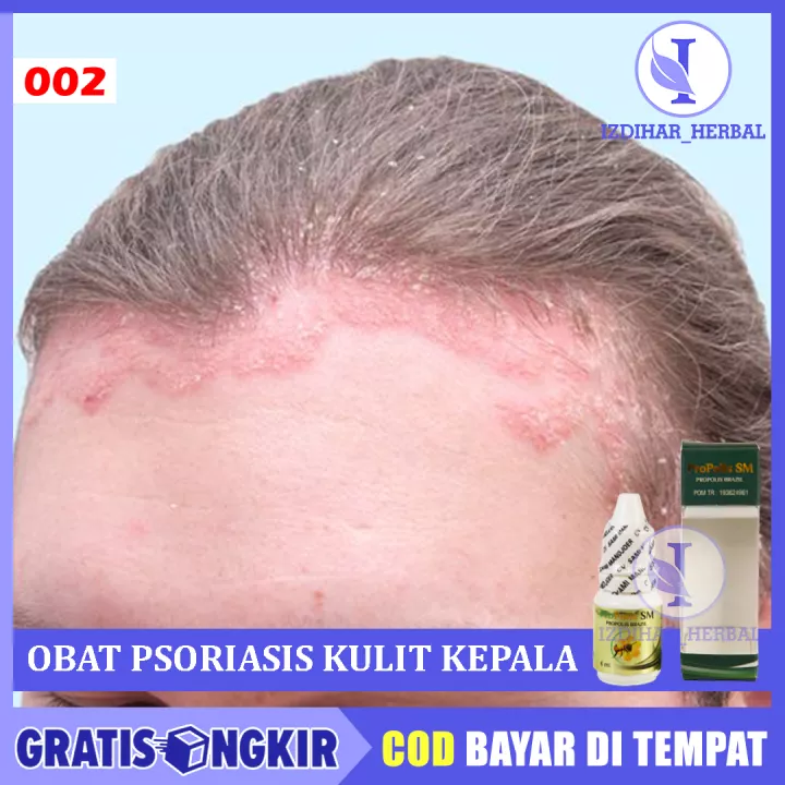 Detail Gambar Psoriasis Kulit Kepala Nomer 55