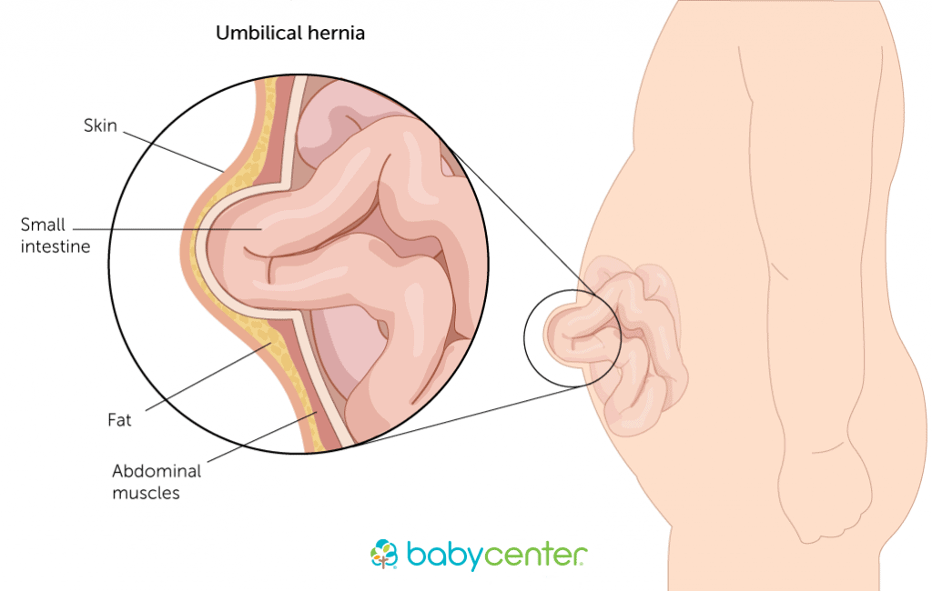 Detail Gambar Pusar Bayi Bodong Nomer 10