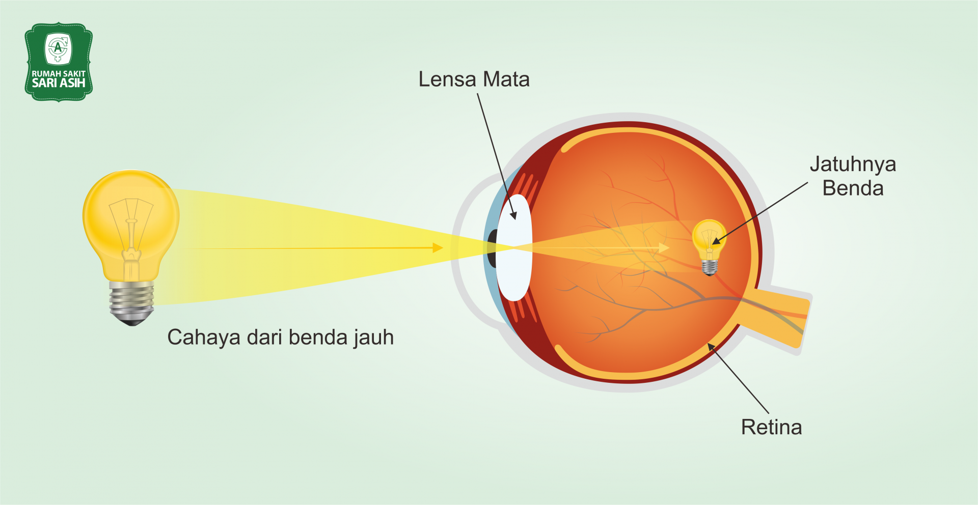 Gambar Rabun Jauh - KibrisPDR