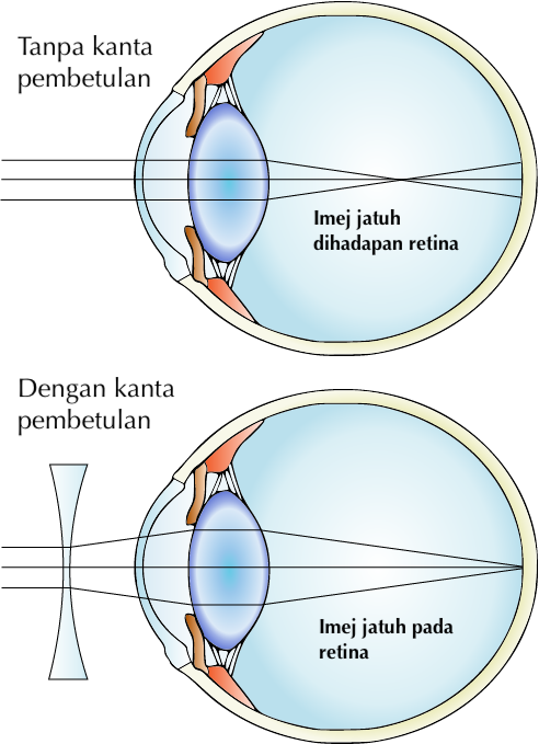 Detail Gambar Rabun Jauh Nomer 21