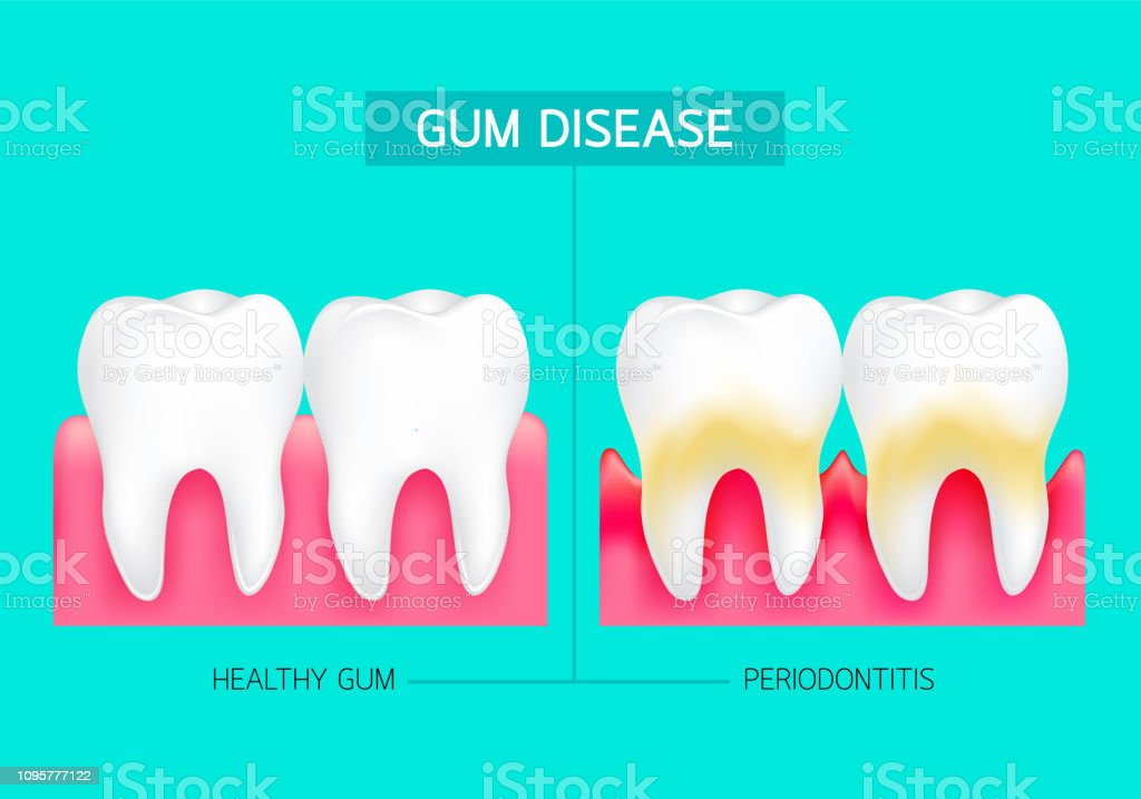 Detail Gambar Radang Gusi Nomer 39