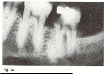 Detail Gambar Radiografi Degenerasi Kalsifik Atau Batu Pulpa Nomer 32
