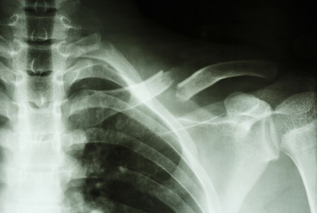 Gambar Radiologi Fraktur Klavikula - KibrisPDR