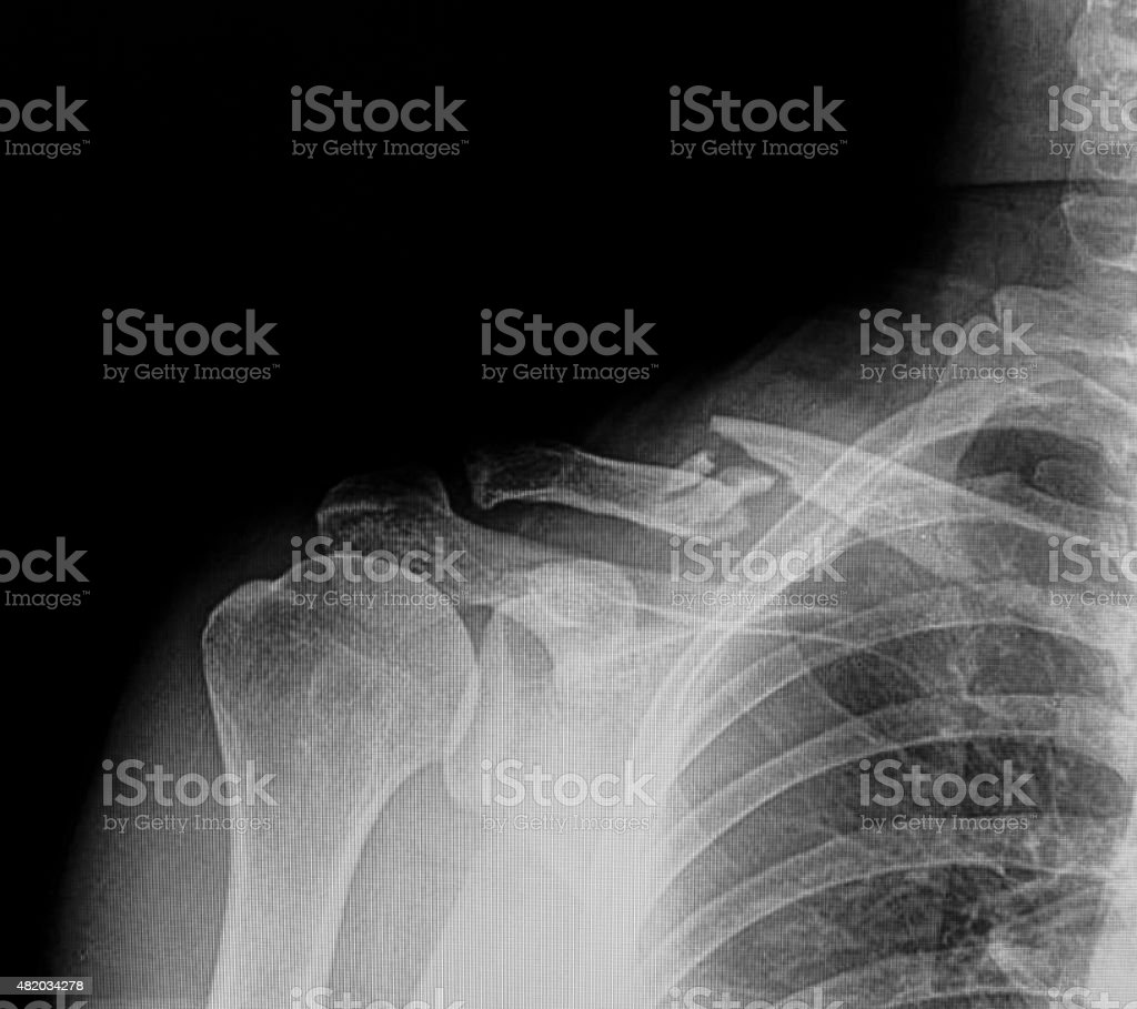 Detail Gambar Radiologi Fraktur Klavikula Nomer 10