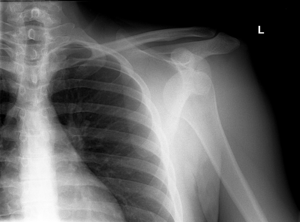 Detail Gambar Radiologi Fraktur Klavikula Nomer 12