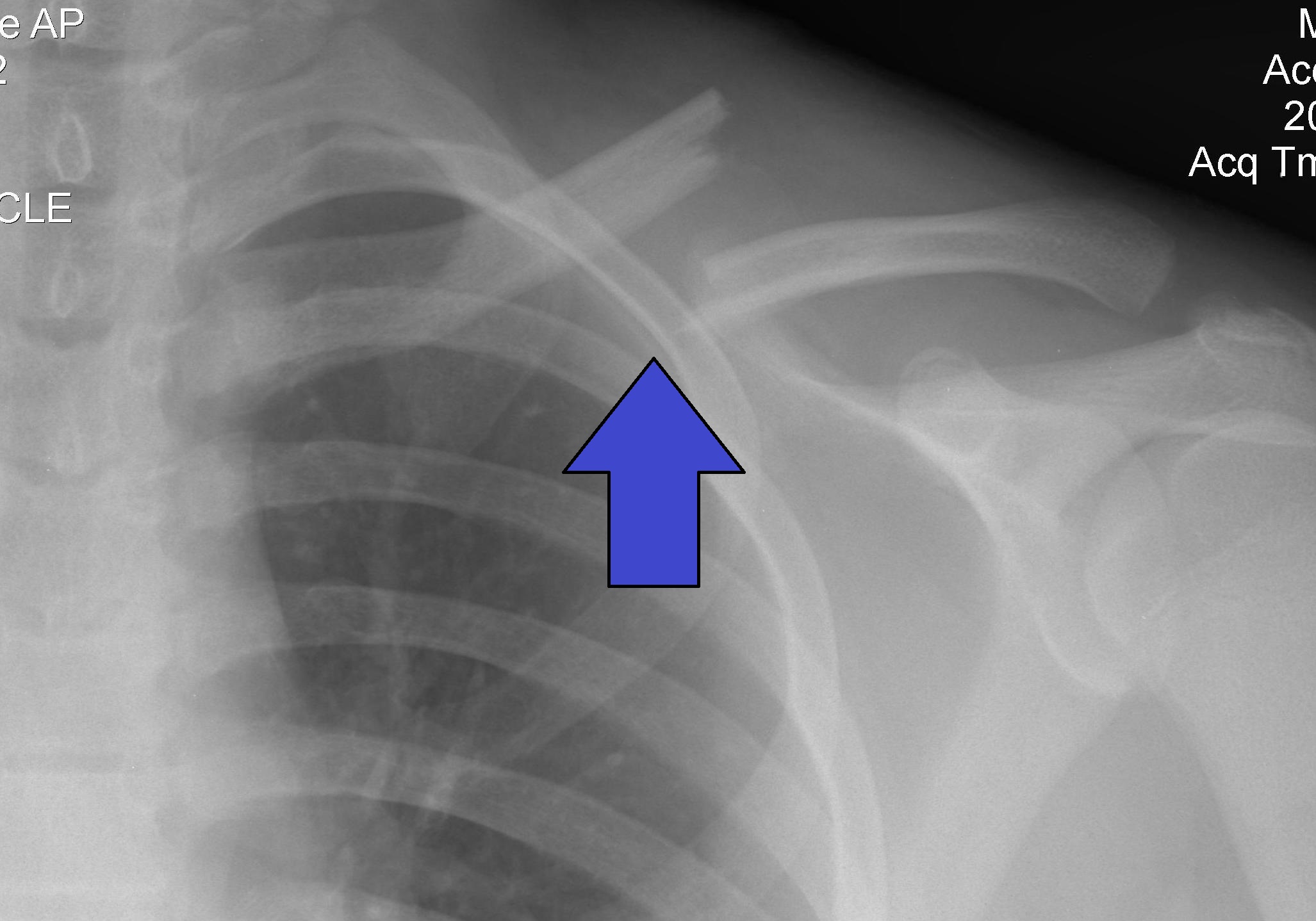 Detail Gambar Radiologi Fraktur Klavikula Nomer 14