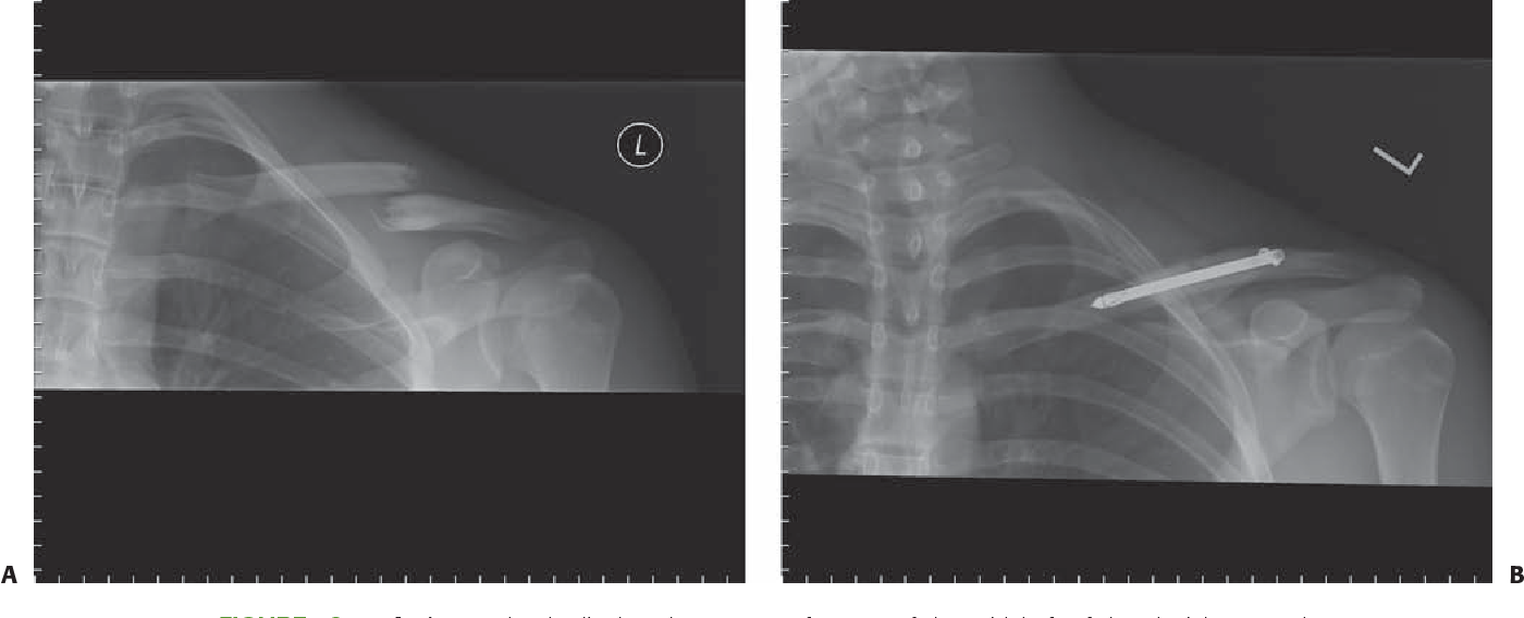 Detail Gambar Radiologi Fraktur Klavikula Nomer 15