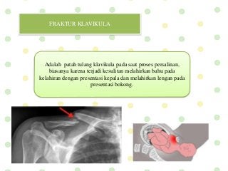 Detail Gambar Radiologi Fraktur Klavikula Nomer 28