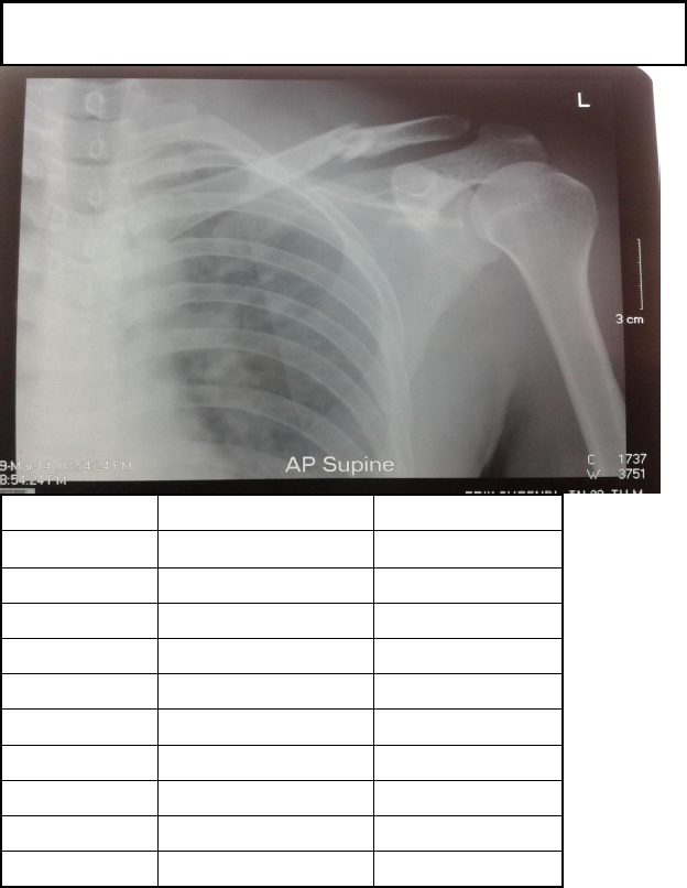 Detail Gambar Radiologi Fraktur Klavikula Nomer 34