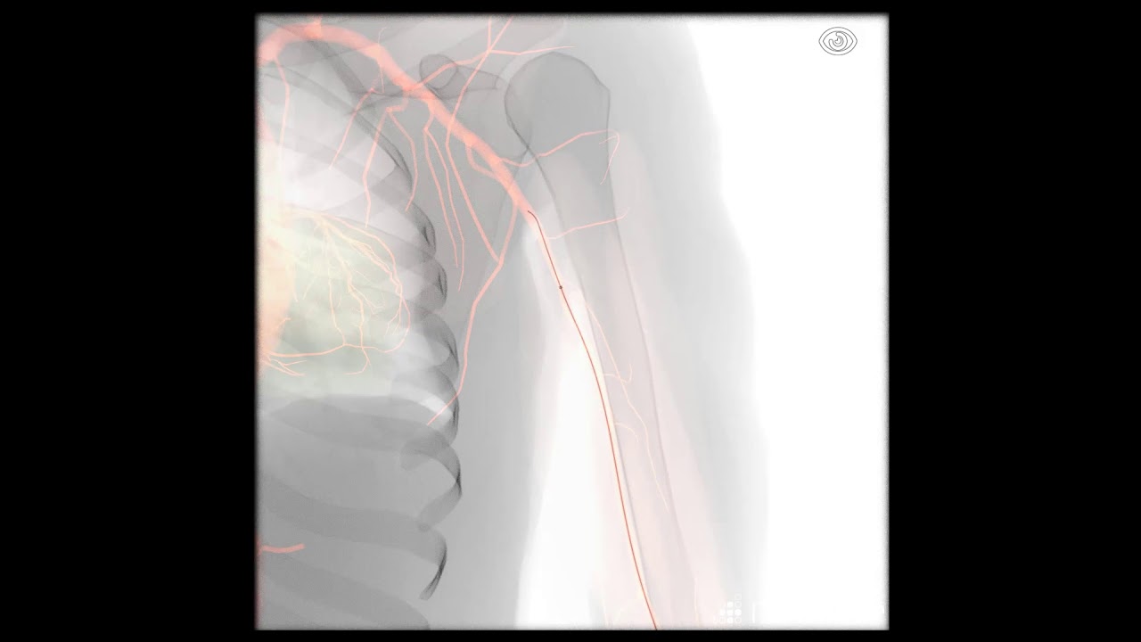 Detail Gambar Radiologi Fraktur Klavikula Nomer 35