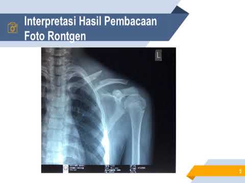 Detail Gambar Radiologi Fraktur Klavikula Nomer 46