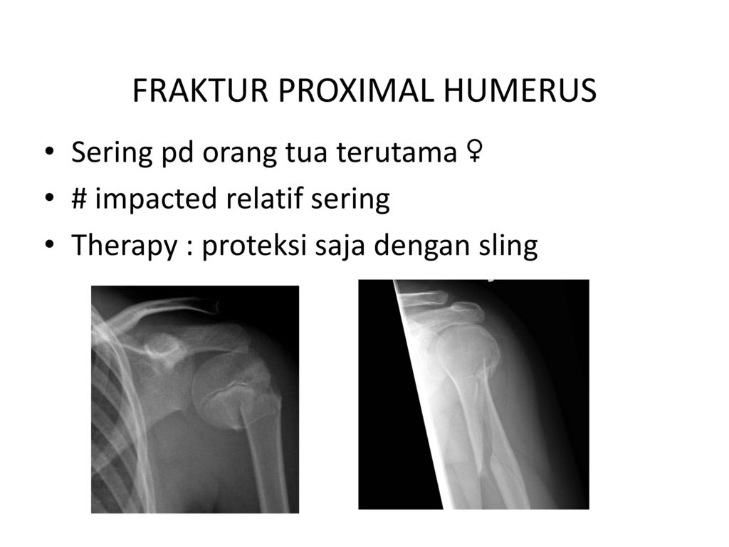 Detail Gambar Radiologi Fraktur Klavikula Nomer 47