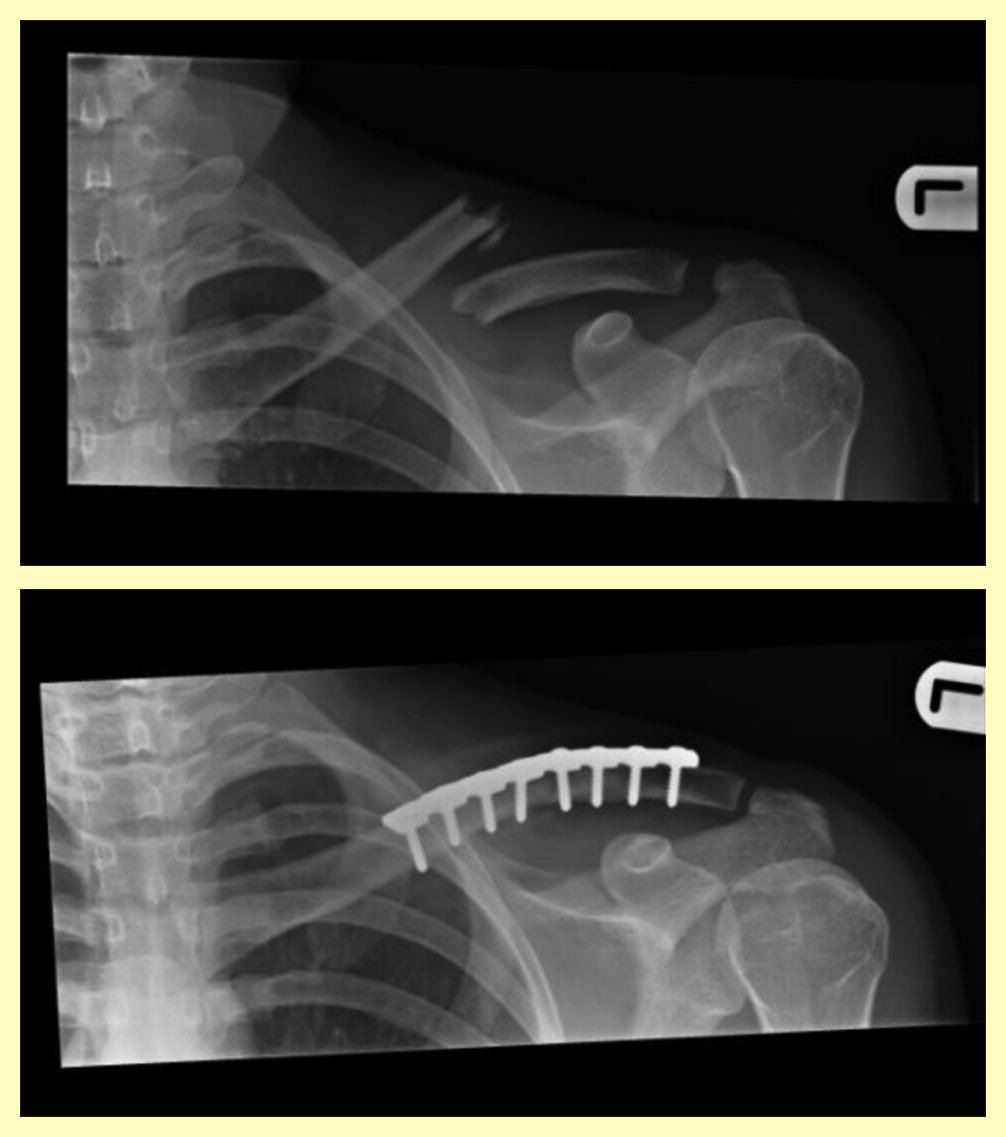 Detail Gambar Radiologi Fraktur Klavikula Nomer 48