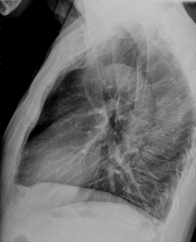 Gambar Radiologi Trauma Sternum - KibrisPDR