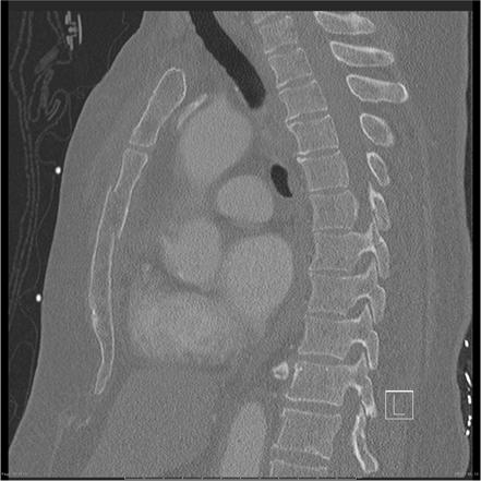 Detail Gambar Radiologi Trauma Sternum Nomer 10