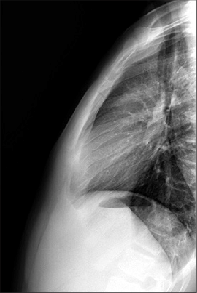 Detail Gambar Radiologi Trauma Sternum Nomer 18