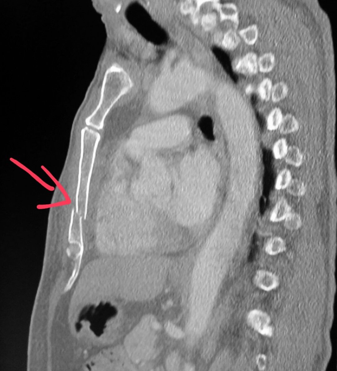 Detail Gambar Radiologi Trauma Sternum Nomer 24