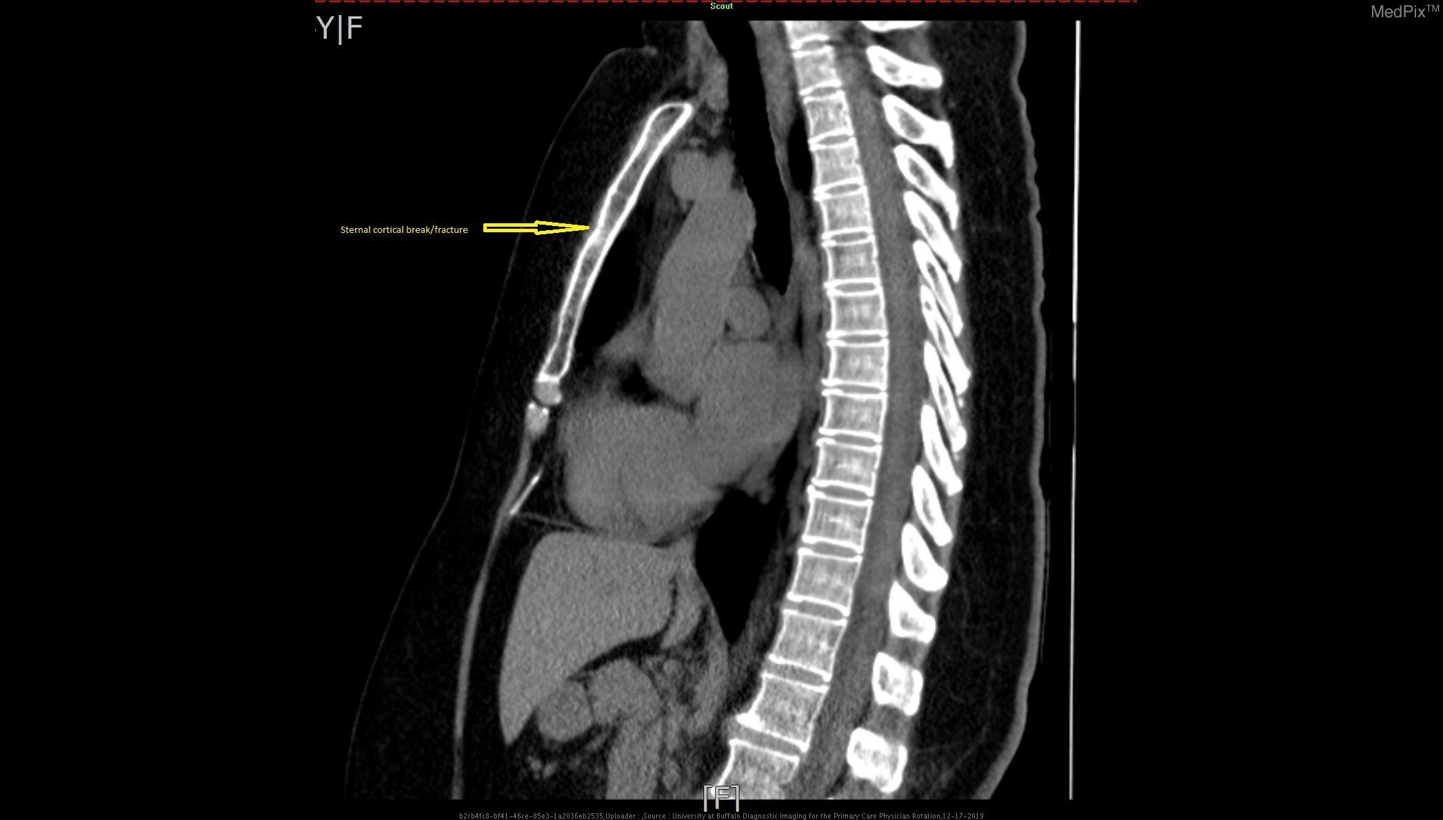 Download Gambar Radiologi Trauma Sternum Nomer 29