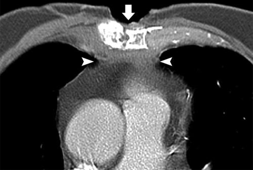 Detail Gambar Radiologi Trauma Sternum Nomer 37