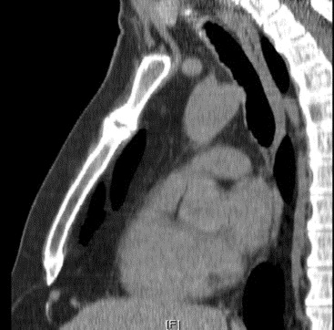 Detail Gambar Radiologi Trauma Sternum Nomer 40