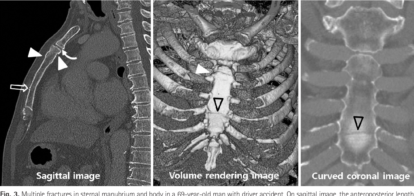 Detail Gambar Radiologi Trauma Sternum Nomer 46
