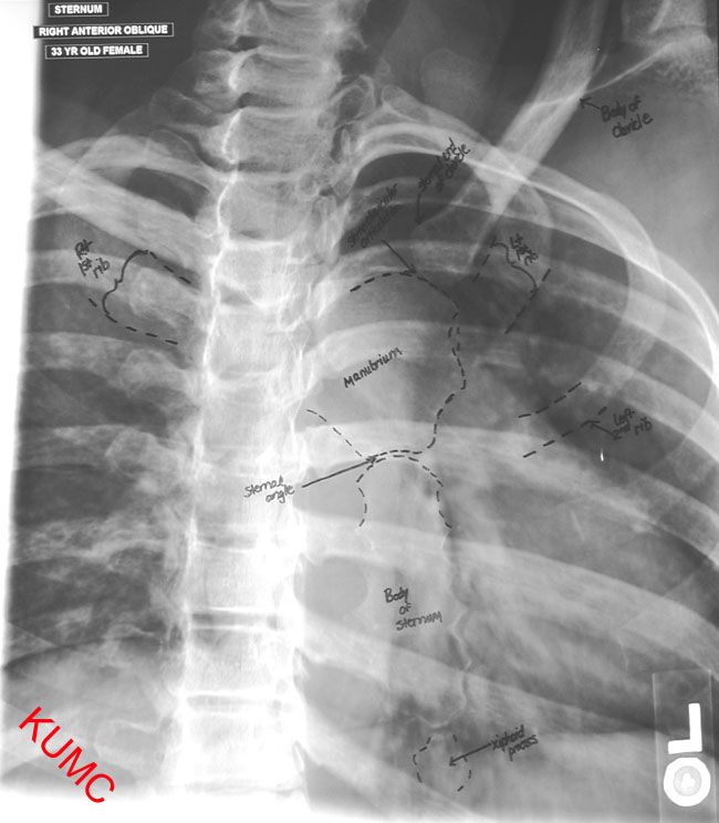 Detail Gambar Radiologi Trauma Sternum Nomer 49