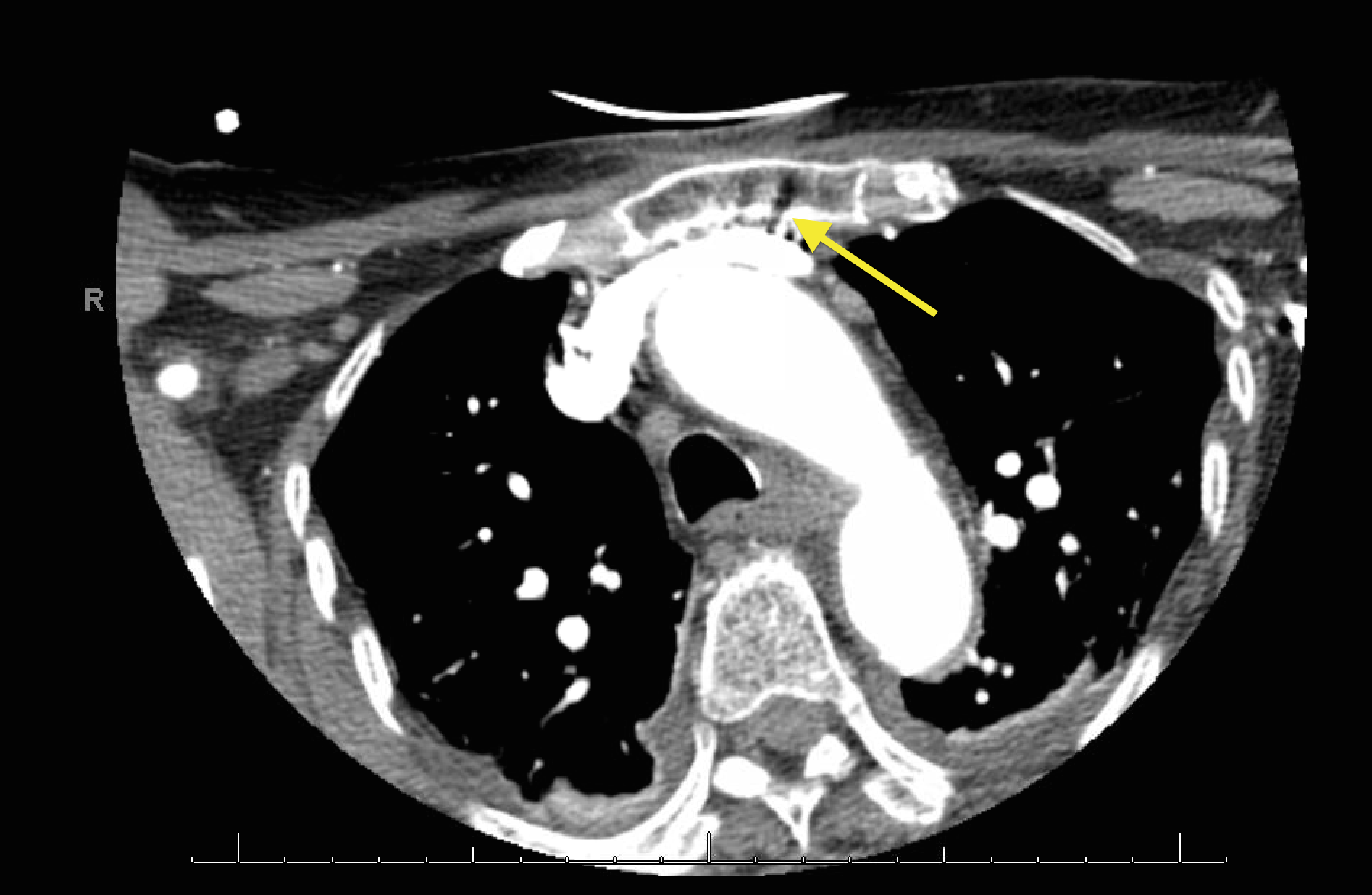 Detail Gambar Radiologi Trauma Sternum Nomer 53